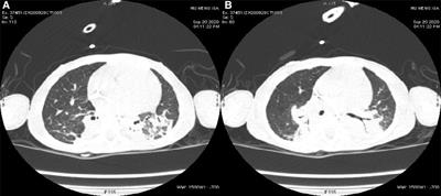 Case report: Fatal infantile hypertonic myofibrillar myopathy with compound heterozygous mutations in the CRYAB gene